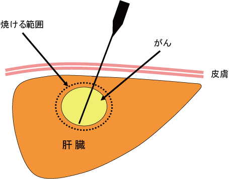 oIWIgĎܗÖ@(RFA)